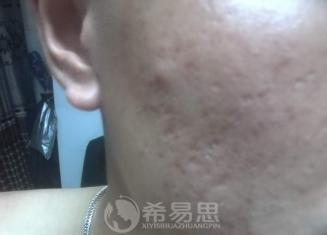 痘坑能改善到什么程度？小羊的真實經歷告訴你答案