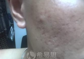 痘坑能改善到什么程度？小羊的真實經歷告訴你答案