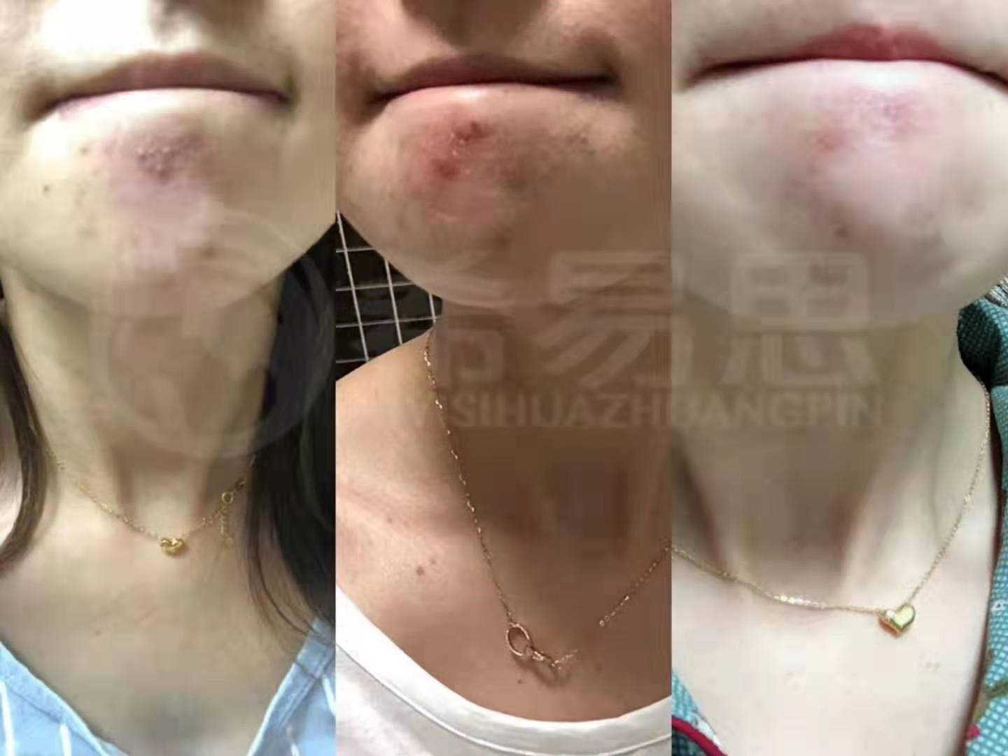 女生下巴長痘的原因，為什么女性下巴容易長痘痘？